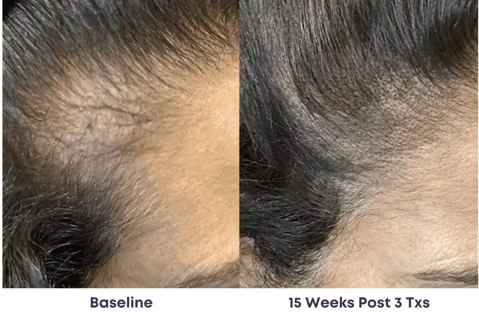 Side-by-side close-up of a hairline shows increased hair density after 15 weeks and three regenerative medicine treatments compared to baseline.