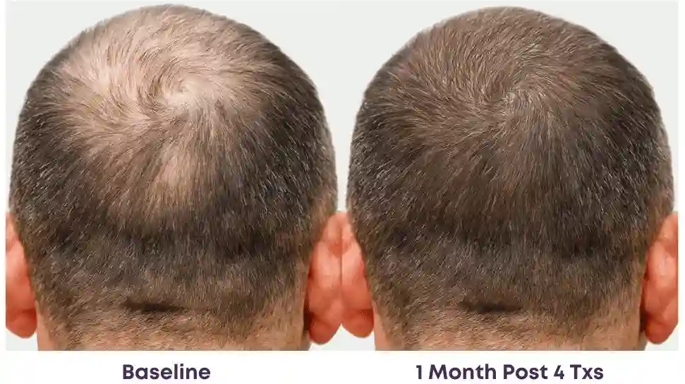 A comparison of the back of a man's head showing reduced scalp visibility and increased hair density after one month of testosterone treatment in a functional medicine clinic in Las Vegas.